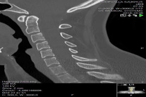Ein Röntgenbild eines Mannes mit einem Bruch im Hals, auf einem Computermonitor angezeigt, mit detaillierten Informationen beschriftet.
