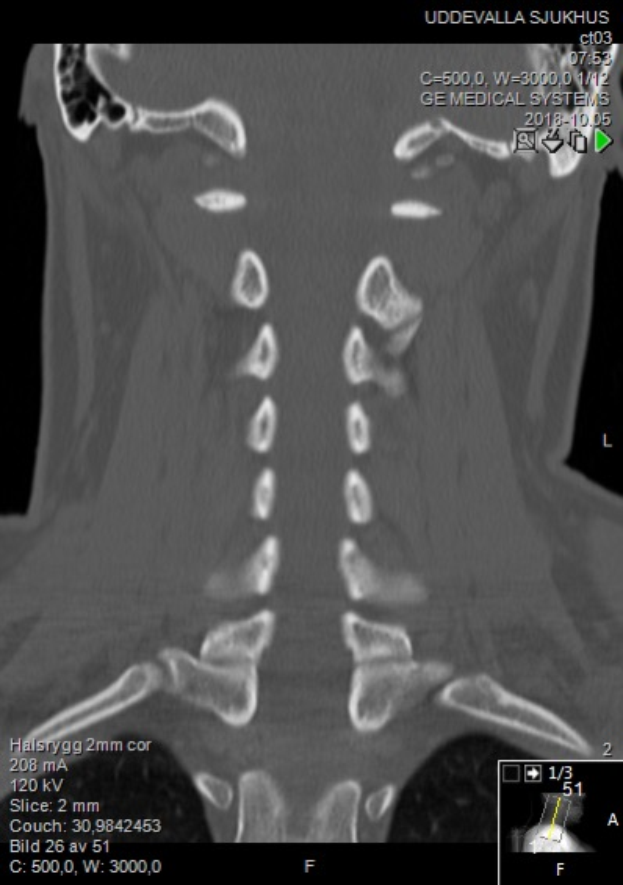 Eine MRT-Aufnahme eines Mannes mit einem Halsbruch, auf einem Computermonitor angezeigt, zeigt die Größe, Form und Lage des Bruchs.